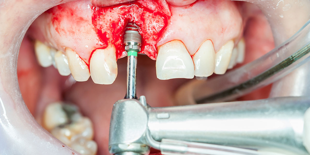 Кровь после имплантации зубов