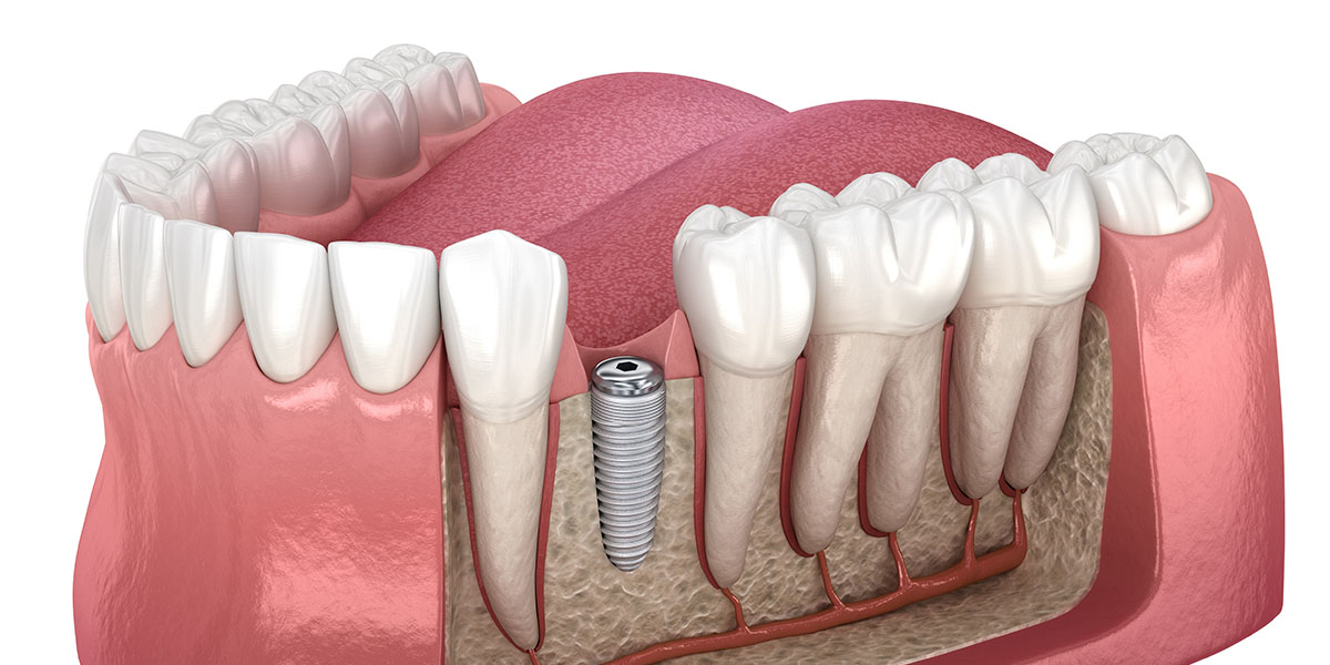 Временные импланты зубов