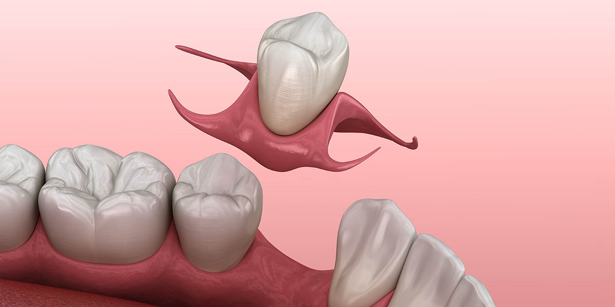Кламмеры в стоматологии